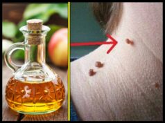 Tu je návod, ako odstrániť kožné výrastky ako sú fibrómy alebo bradavičky jednoducho a prirodzene domácim receptom!