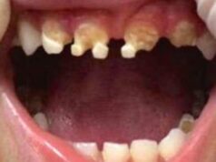 Takto vyzerajú zuby 3-ročného chlapca. Budete sa diviť, čo mu jeho matka dávala na pitie!