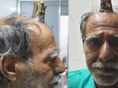 Mužovi vyrástol na hlave 10centimetrový diablov roh! Ohavnosť mu skracoval holič